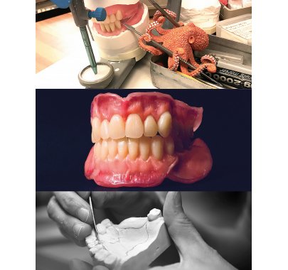 Prothèse complète adjointe