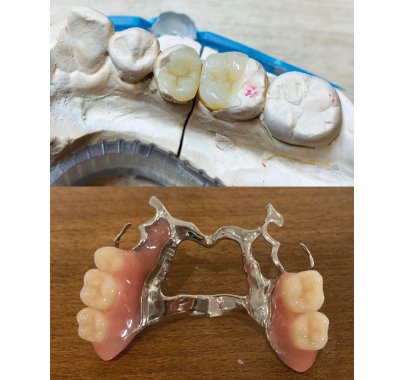 Prothèse partielle métallique adjointe