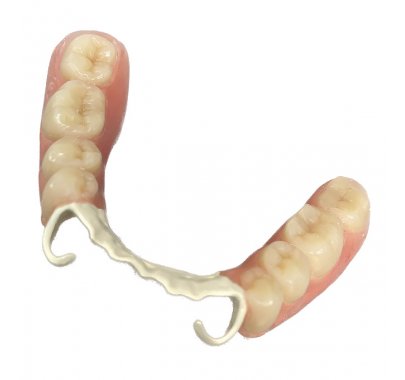 Prothèse partielle métallique adjointe avec attachement