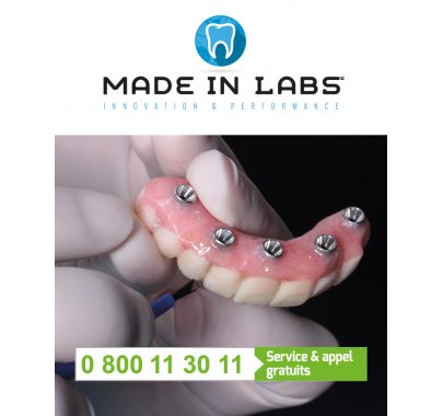 Prothèse sur implant