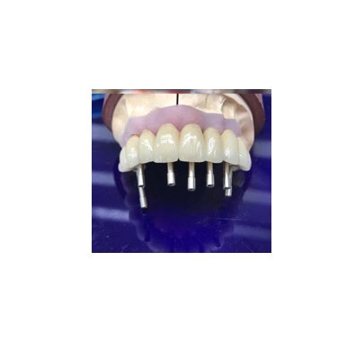 Prothèse sur implant