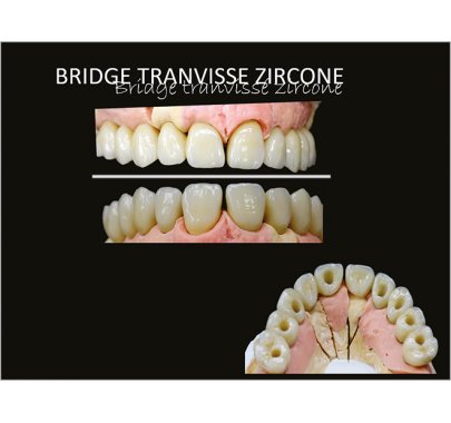 Prothèse sur implant