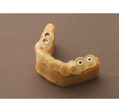 Prothèse sur implant
