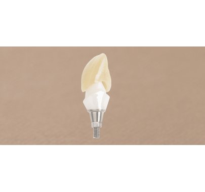 Prothèse sur implant