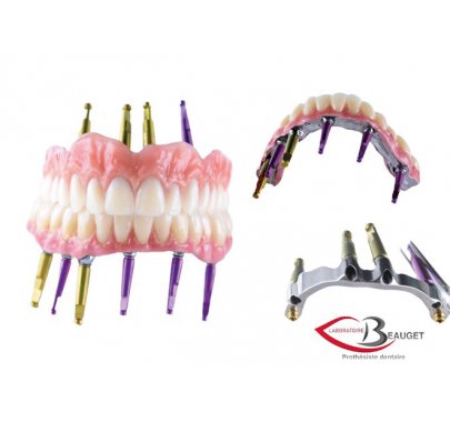 Prothèse sur implant