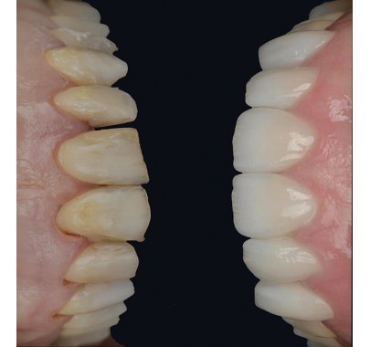 Prothèse sur implant