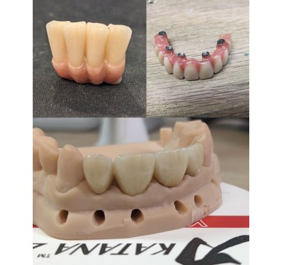 Prothèse sur implant