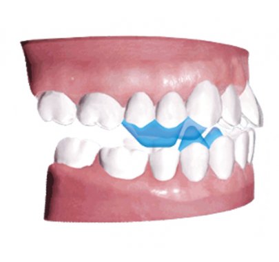 Système d'évaluation d'occlusion